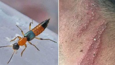 Two persons infected by Nairobi fly receiving treatment in Kathmandu